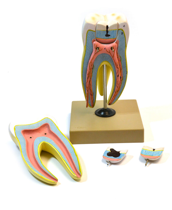 Model Upper Triple Root Molar with Caries 15 times Full size - 6 Parts